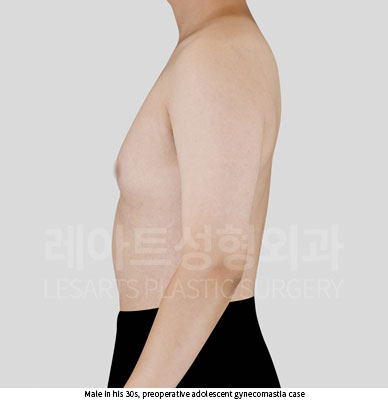 gynecomastia-02-02-251015