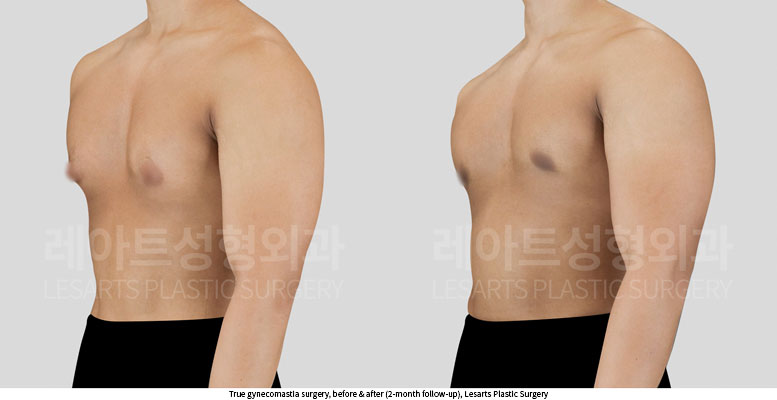 gynecomastia-02-03-251014