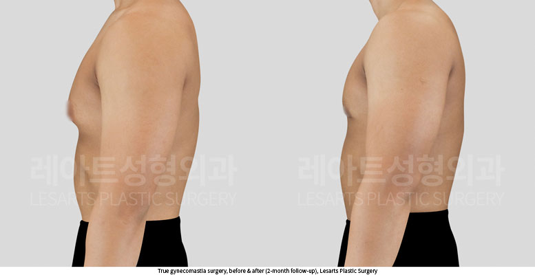 gynecomastia-02-04-251014