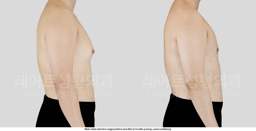 gynecomastia-02-04-251015
