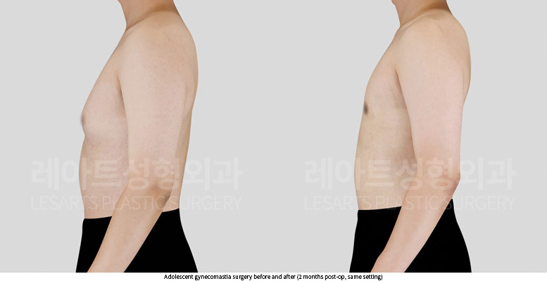 gynecomastia-02-04-251015