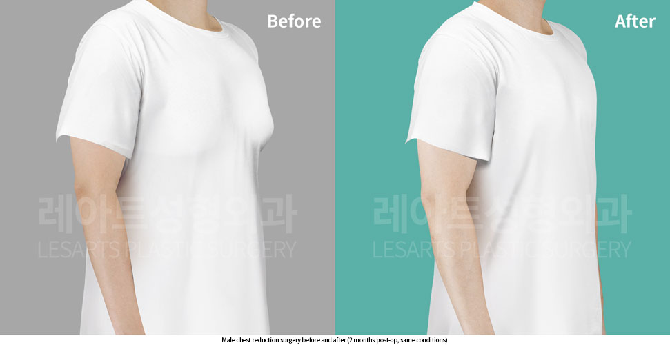 gynecomastia-02-05-251015