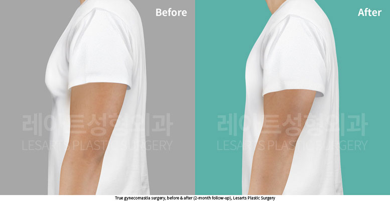 gynecomastia-02-06-251014