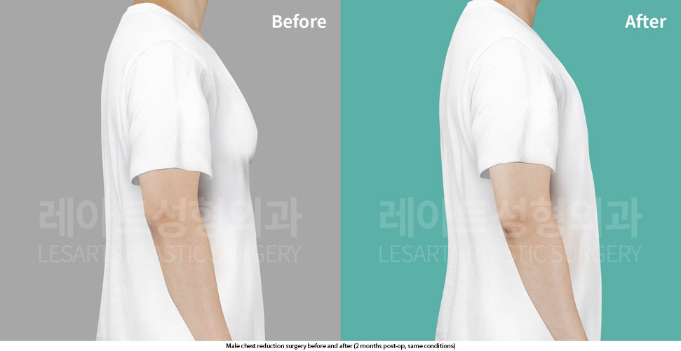 gynecomastia-02-06-251015