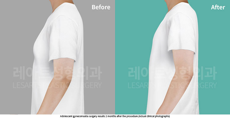 gynecomastia-02-06-251015