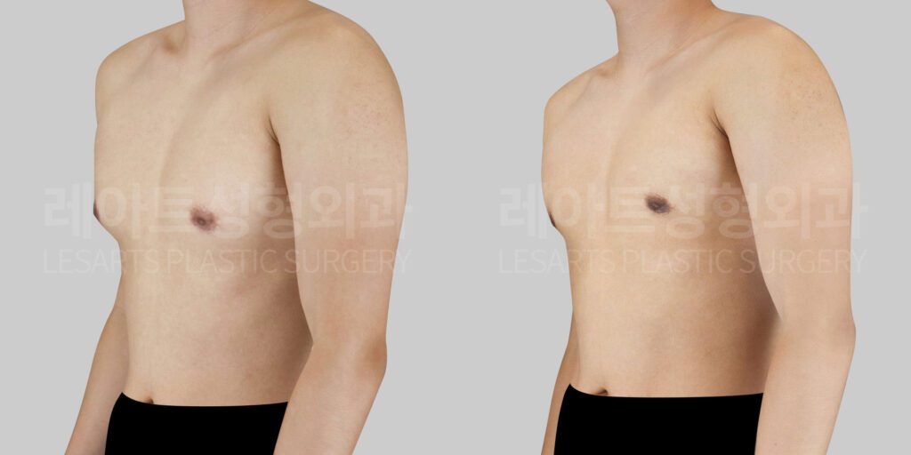 gynecomastia-29680-before-and-after-45degree