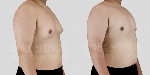 gynecomastia_01_thumbnail_250929