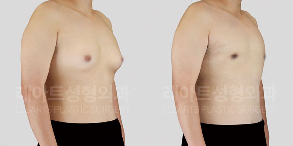 gynecomastia_01_thumbnail_251002