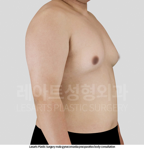gynecomastia_02_01_250929