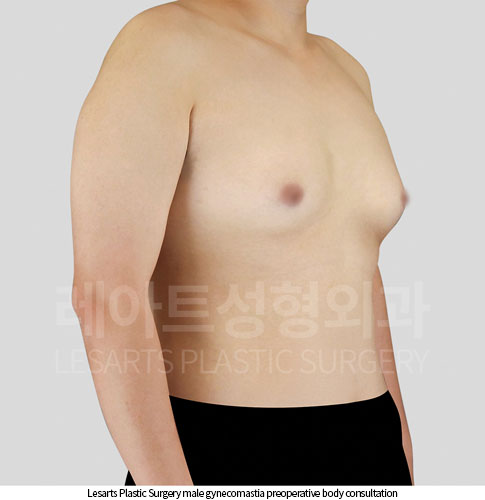 gynecomastia_01_thumbnail_251002