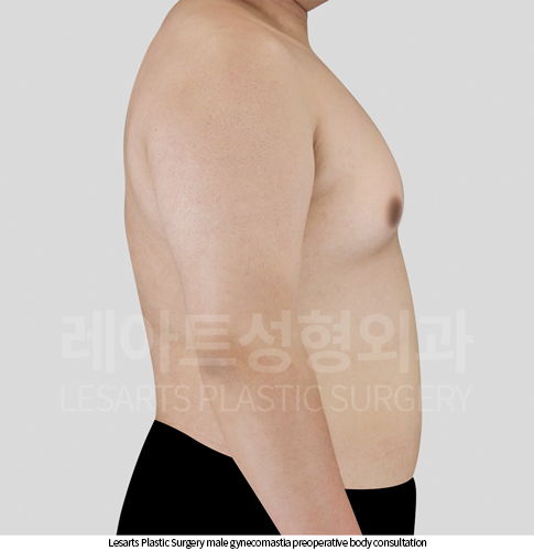 gynecomastia_02_02_250929