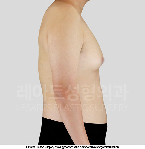 gynecomastia_02_02_251002