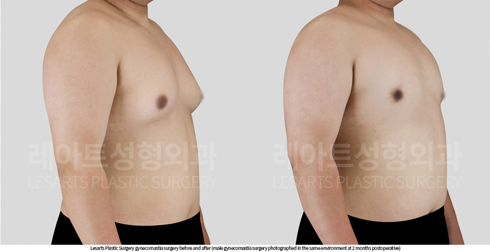 gynecomastia_02_03_250929