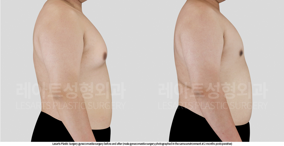 gynecomastia_02_04_250929