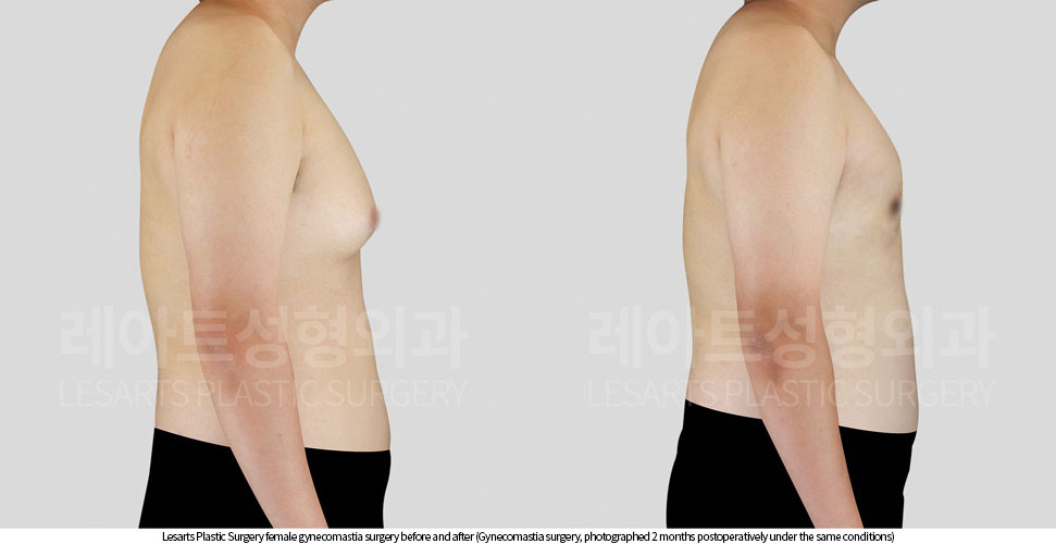 gynecomastia_02_04_251002