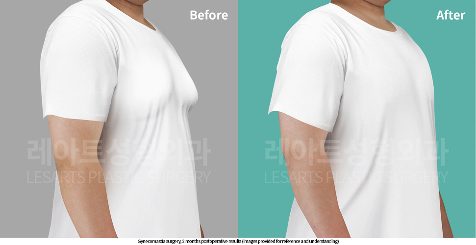gynecomastia_02_05_250929