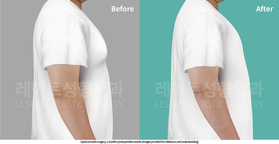 gynecomastia_02_06_250929