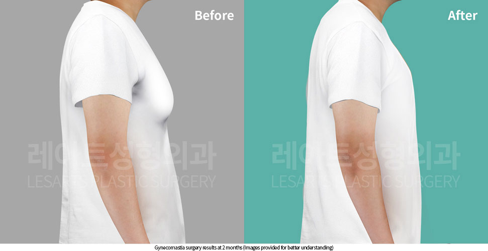 gynecomastia_02_06_251002