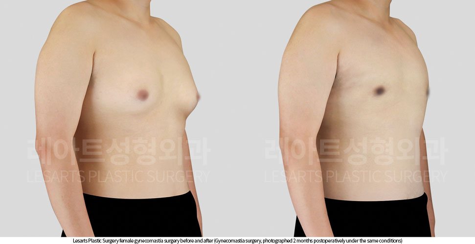gynecomastia_before_and_after_02_03_251002