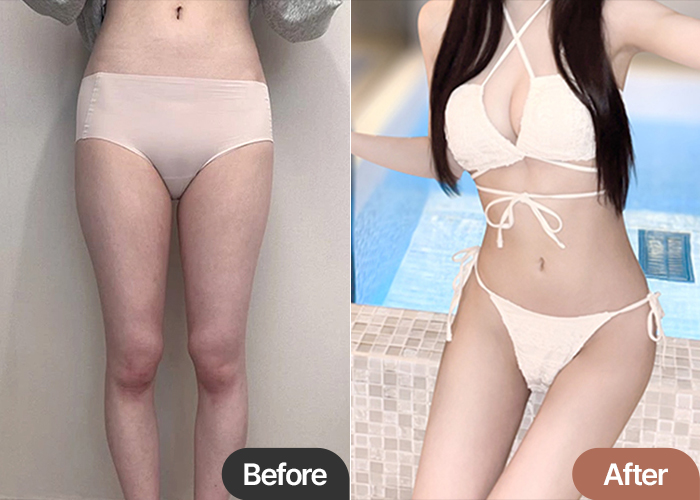 Patrasheubung thigh liposuction before and after comparison – Best Liposuction Clinic in Korea Lesarts