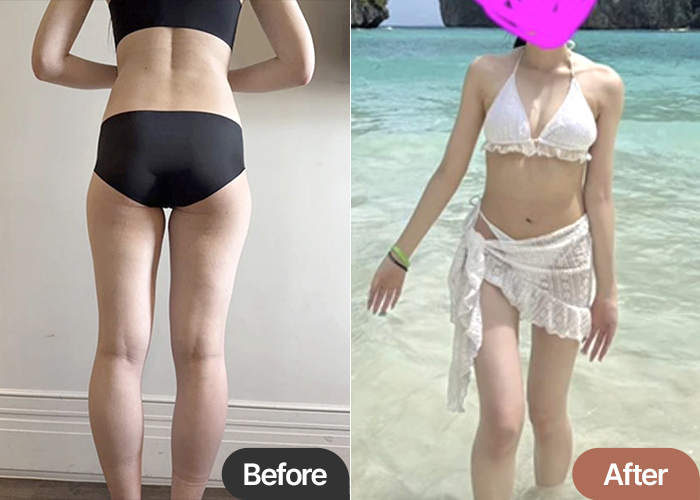 Patrasubung thigh liposuction before and after results showing thigh gap – Best Liposuction Clinic in Korea Lesarts