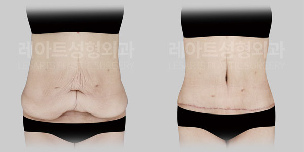 tummy-tuck-01-thumbnail-251002