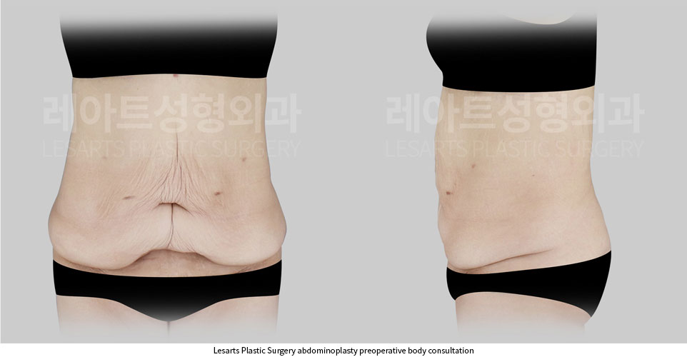 tummy-tuck-01-thumbnail-251002