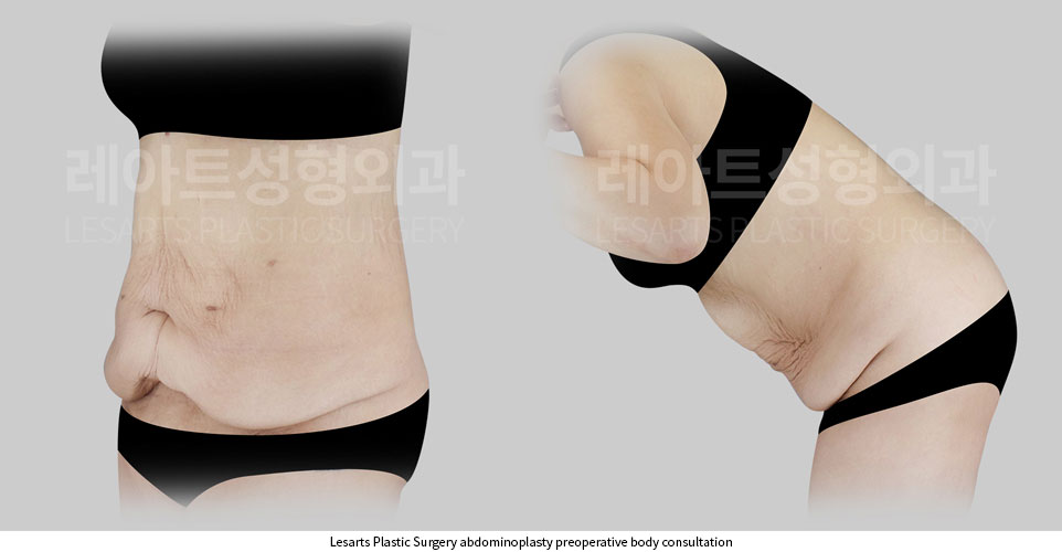 tummy-tuck-02-02-251002