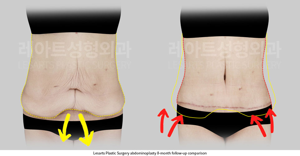 tummy-tuck-02-03-251002