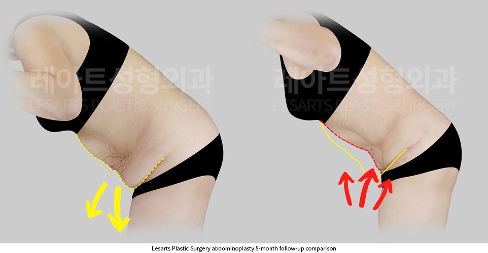 tummy-tuck-02-04-251002