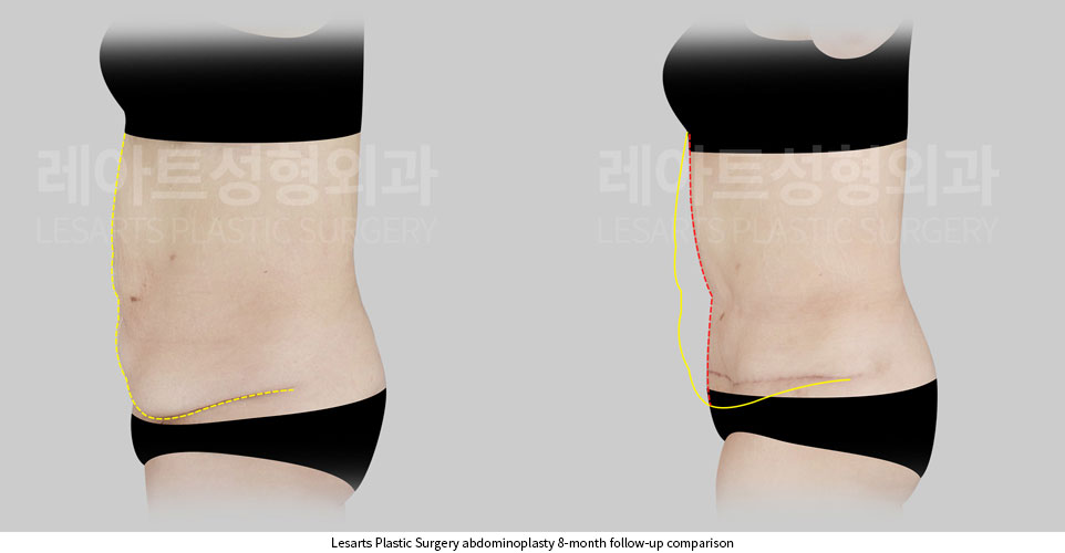 tummy-tuck-02-06-251002