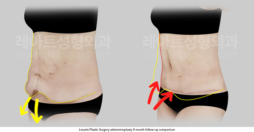 tummy-tuck-before-and-after-02-05-251002