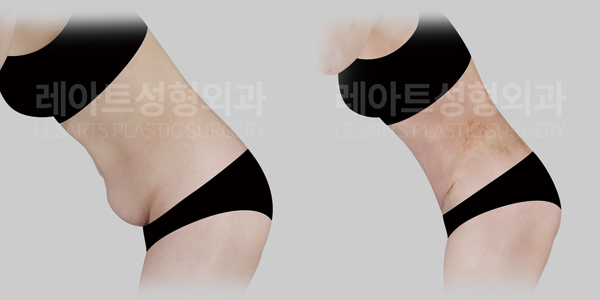 tummy_tuck_01_thumbnail_250930