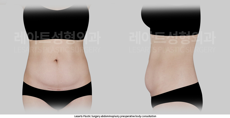 tummy_tuck_02_01_250930