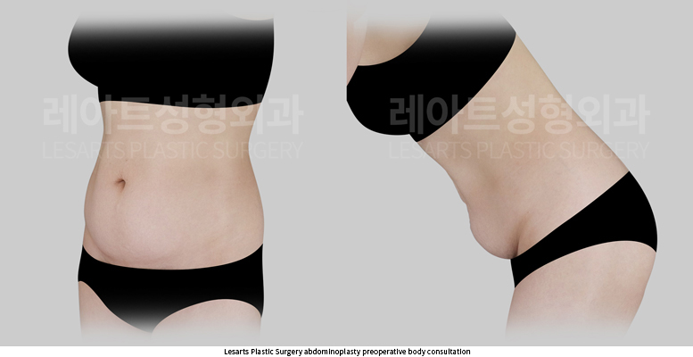 tummy_tuck_02_02_250930