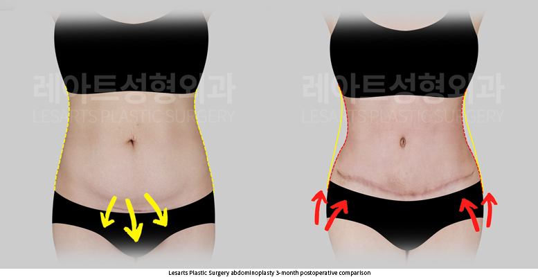 tummy_tuck_02_03_250930