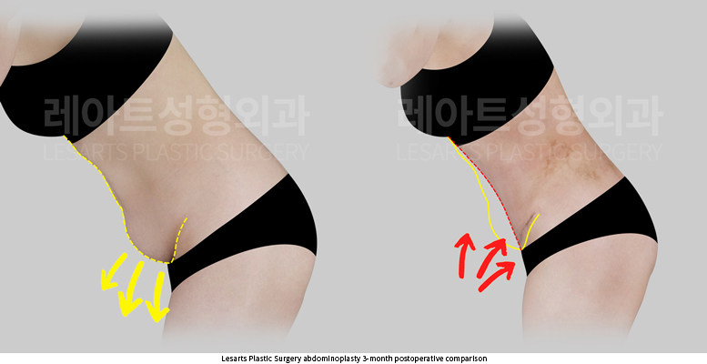 tummy_tuck_02_04_250930