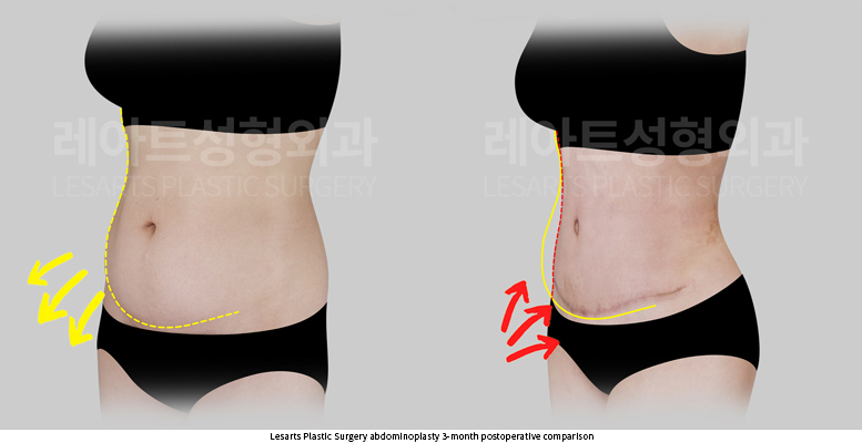 tummy_tuck_02_05_250930