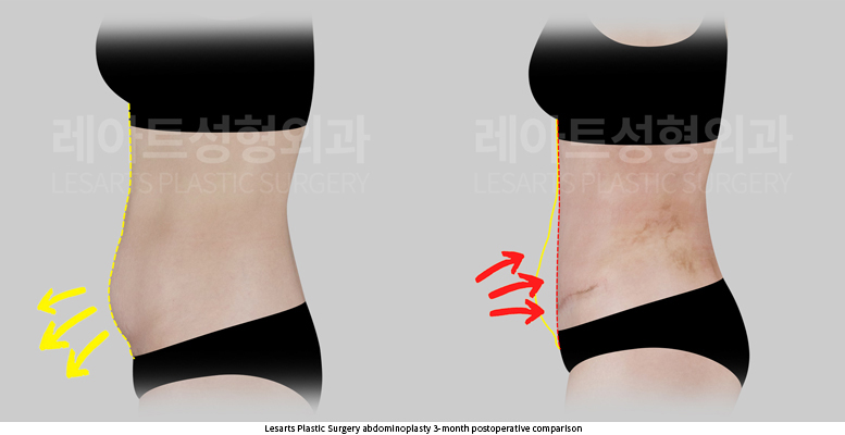 tummy_tuck_02_06_250930