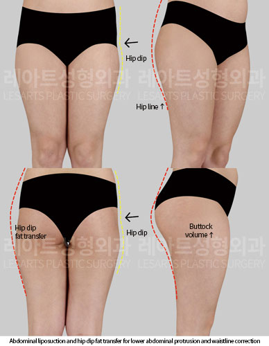 abdominal-liposuction-02-02-251016