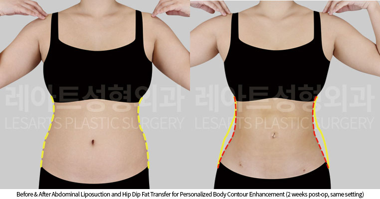 abdominal-liposuction-02-03-251016