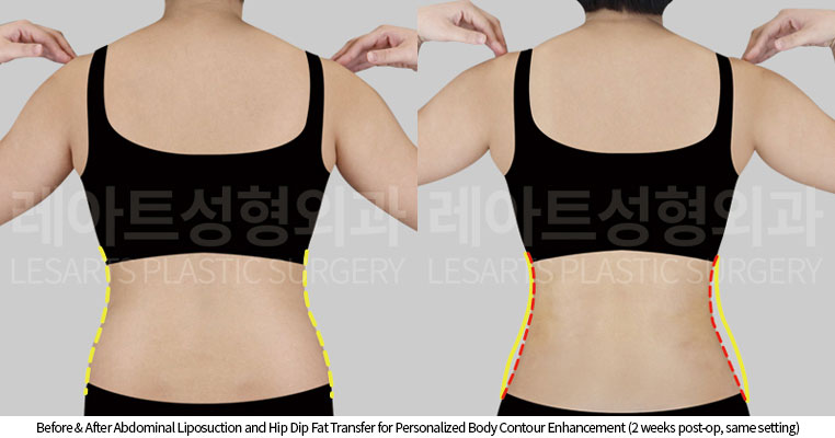 abdominal-liposuction-02-04-251016
