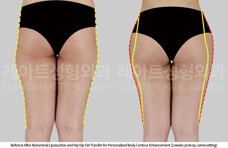 abdominal-liposuction-02-06-251016