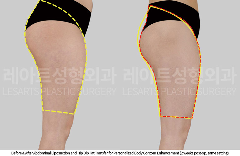 abdominal-liposuction-02-08-251016