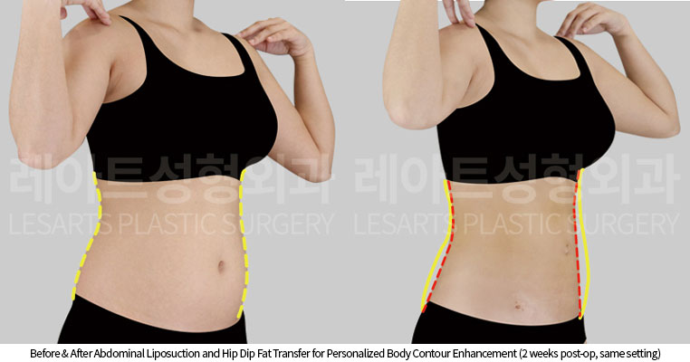 abdominal-liposuction-02-09-251016