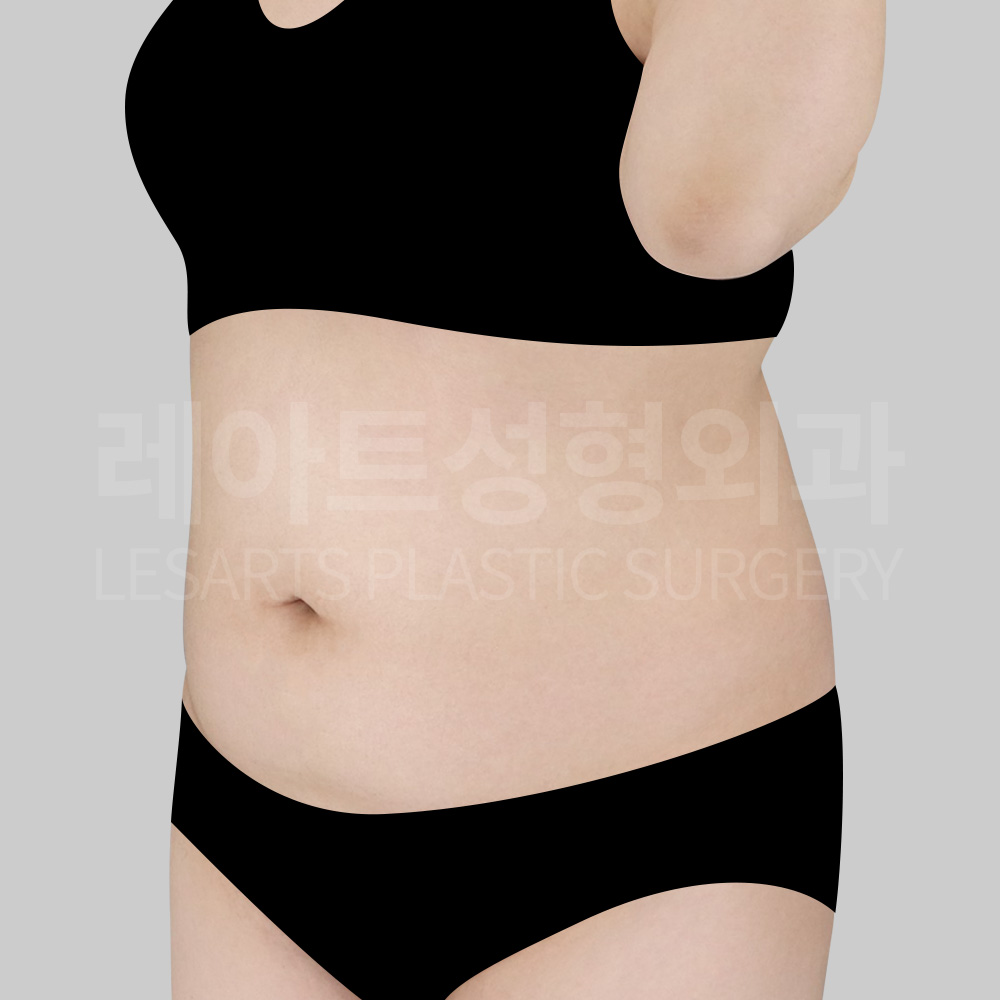 abdominal-liposuction-25534-before-45degree