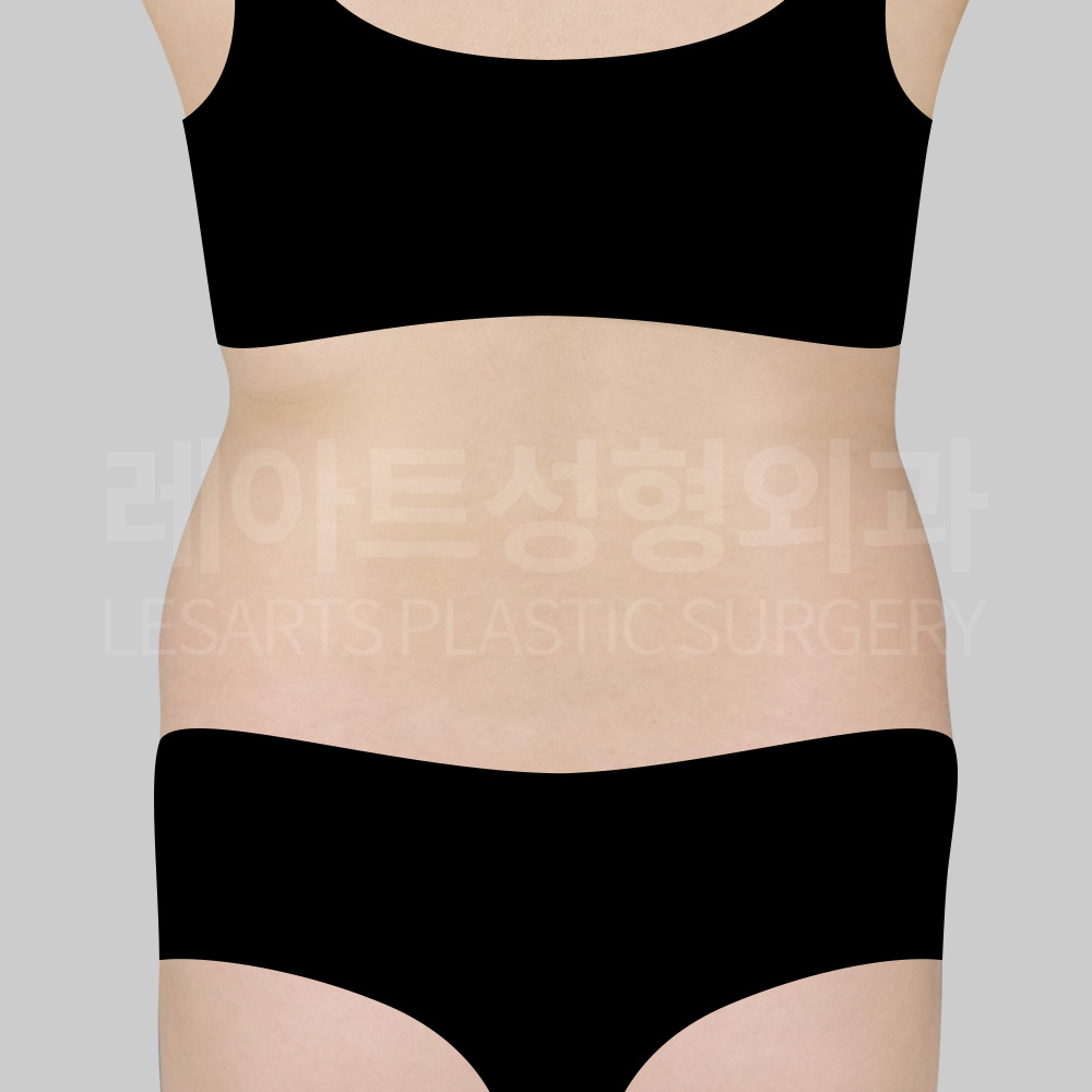 abdominal-liposuction-25534-before-back