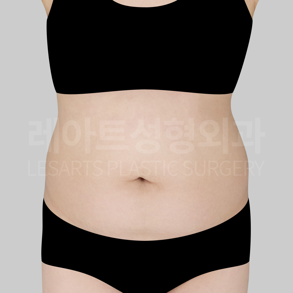abdominal-liposuction-25534-before-front