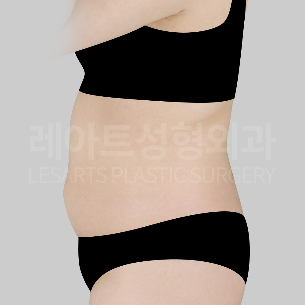 abdominal-liposuction-25534-before-side