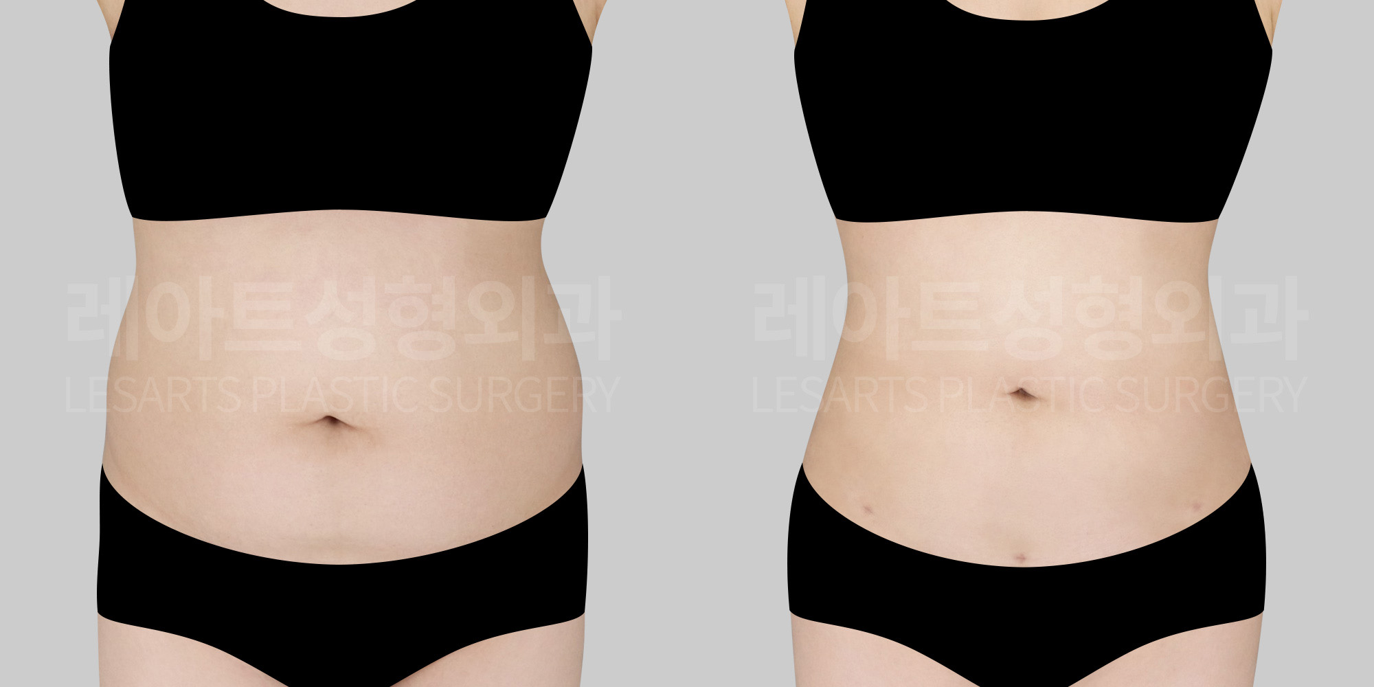 Abdominal Liposuction – How Much Can Surgery Change a Petite Woman’s Straight Waist?
